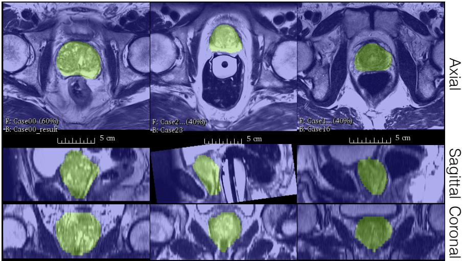 Qualitative segmentation results from three cases, seen in axial, sagittal, and coronal planes.