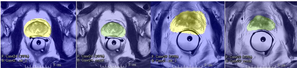 Qualitative comparison showing segmentations from Dice loss model (green) vs weighted softmax loss (yellow).