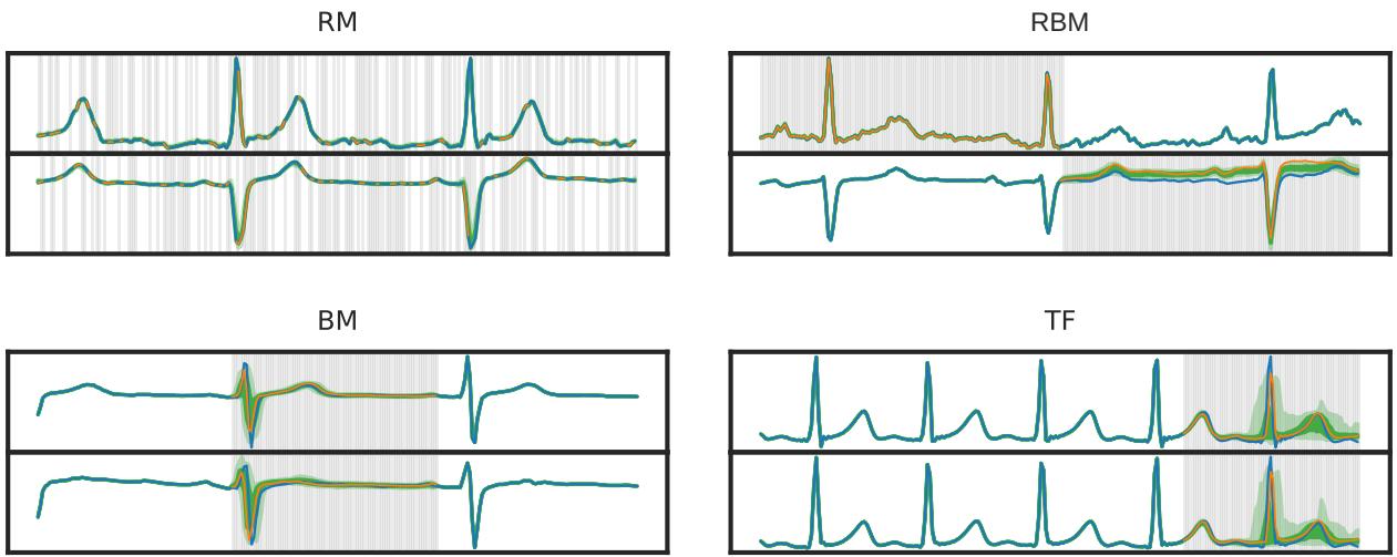 Different missingness scenarios for time series data. RM: random missing points. RBM: random blocks missing in different channels. BM: a single blackout block missing across all channels. TF: time series forecasting, a special case of BM.