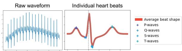 ECG 可视化示例。