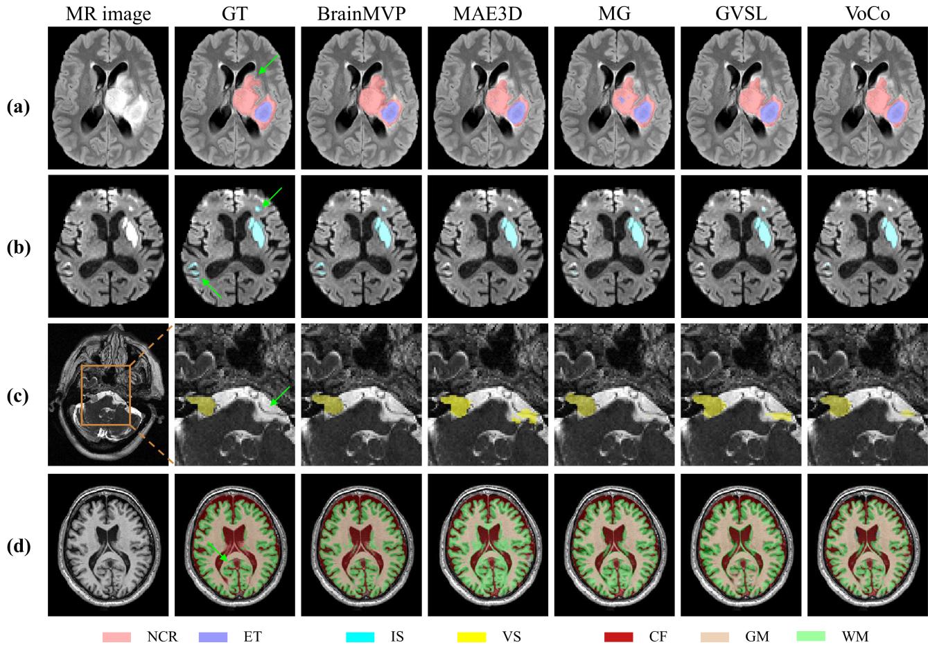 Figure 6. Visual comparison of segmentation results. BrainMVP produces segmentations that are closest to the Ground Truth (GT), avoiding the under-segmentation seen in other methods.