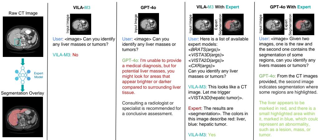 Qualitative Comparison on Tumor Detection. The figure shows VILA-M3 and GPT-4o attempting to detect a liver tumor. Without expert segmentation, both fail. With expert guidance (segmentation overlay), both models successfully identify the tumor.