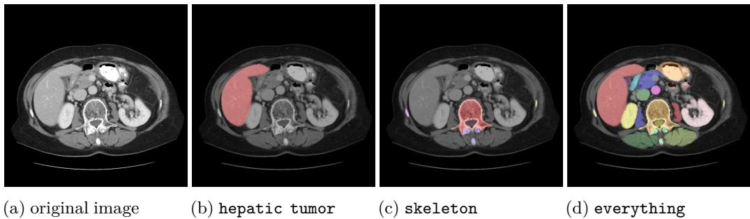 CT Scan Segmentation Examples. Panel (a) shows the original CT slice. Panels (b-d) show VILA-M3 successfully calling the VISTA3D expert with different arguments: &lsquo;hepatic tumor&rsquo;, &lsquo;skeleton&rsquo;, and &rsquo;everything&rsquo;.
