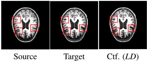Brain aging example transforming a 70-year-old CN brain to a 77-year-old MCI brain.