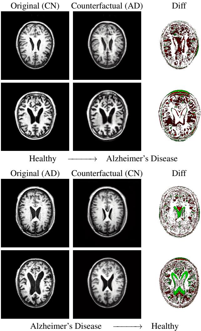 Counterfactual MRI slices showing transformation between Alzheimer&rsquo;s and Healthy states.