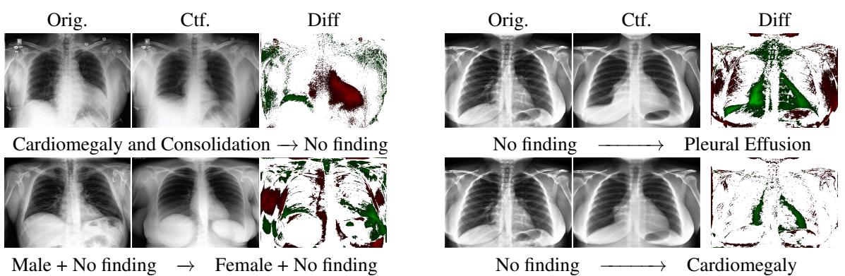 Counterfactual samples on Chest X-rays showing addition and removal of diseases.