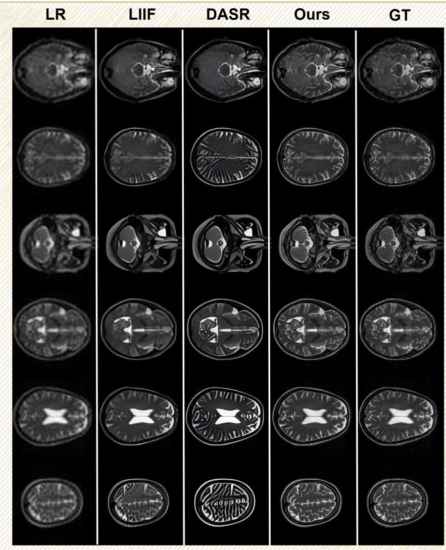 Figure 12: Case of MRI image super-resolution.