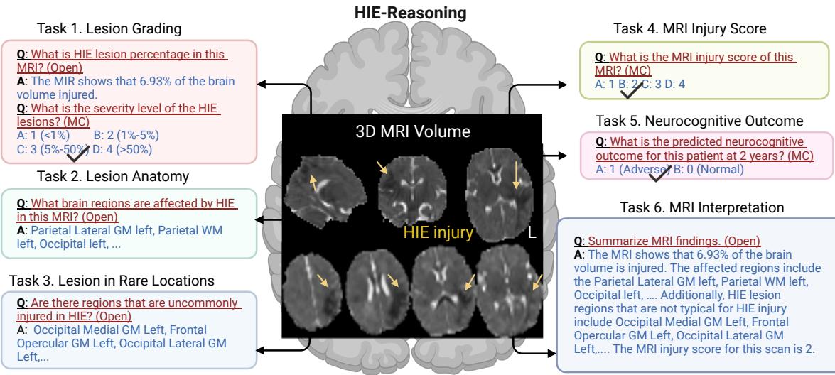 Figure 2. HIE-Reasoning Dataset and Task Overview. A central brain MRI is surrounded by six specific tasks: Lesion Grading, Lesion Anatomy, Lesion in Rare Locations, MRI Injury Score, Neurocognitive Outcome, and MRI Interpretation.