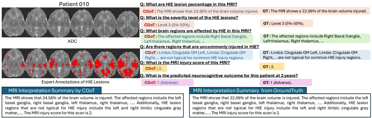 Figure 4. Qualitative result of CGoT. A comparison between the CGoT output and Ground Truth (GT) for Patient 010. The model correctly identifies injury percentage, severity, specific regions (Right Basal Ganglia), and the final adverse outcome.
