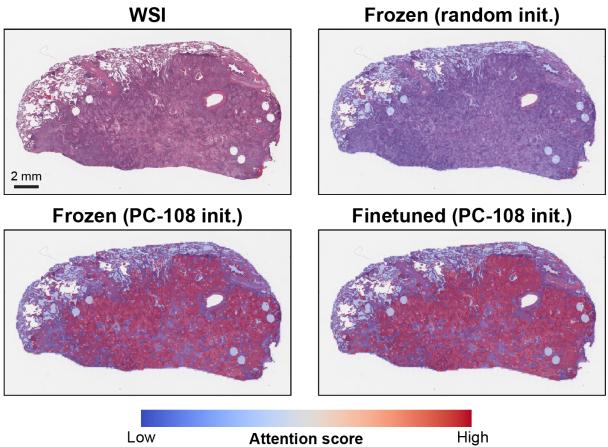 Figure 6. Heatmaps for visualizing attention transfer. Visualization of the three different ABMIL attention heatmaps for lung squamous cell carcinoma.
