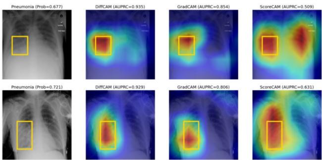 Comparison of Pneumonia detection on X-rays. DiffCAM (middle-left) accurately highlights the lung opacity (yellow box), whereas ScoreCAM and GradCAM highlight irrelevant areas.
